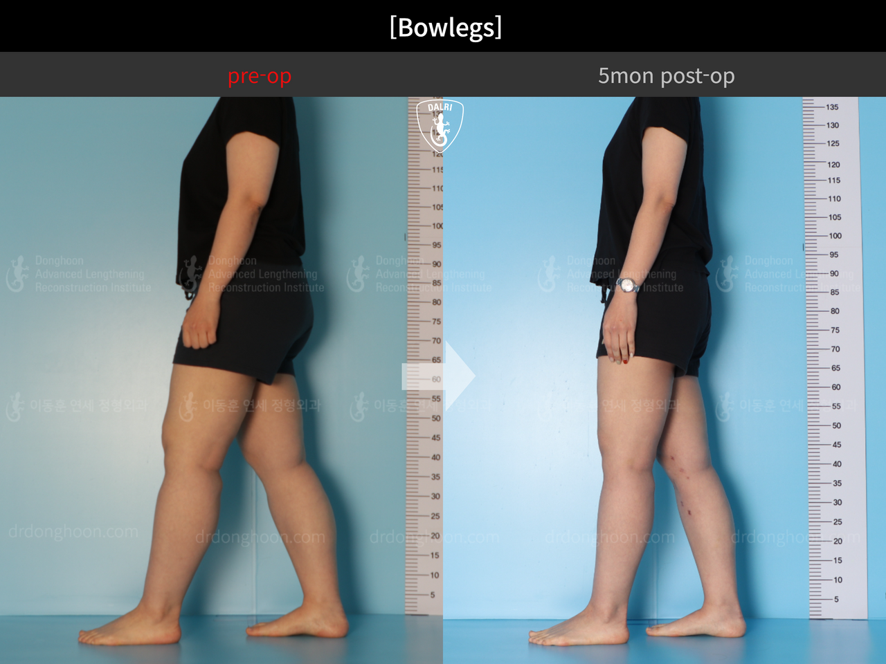Before and after adult bowlegs, case 13212059, image 8, Dr. Donghoon institute (DALRI)