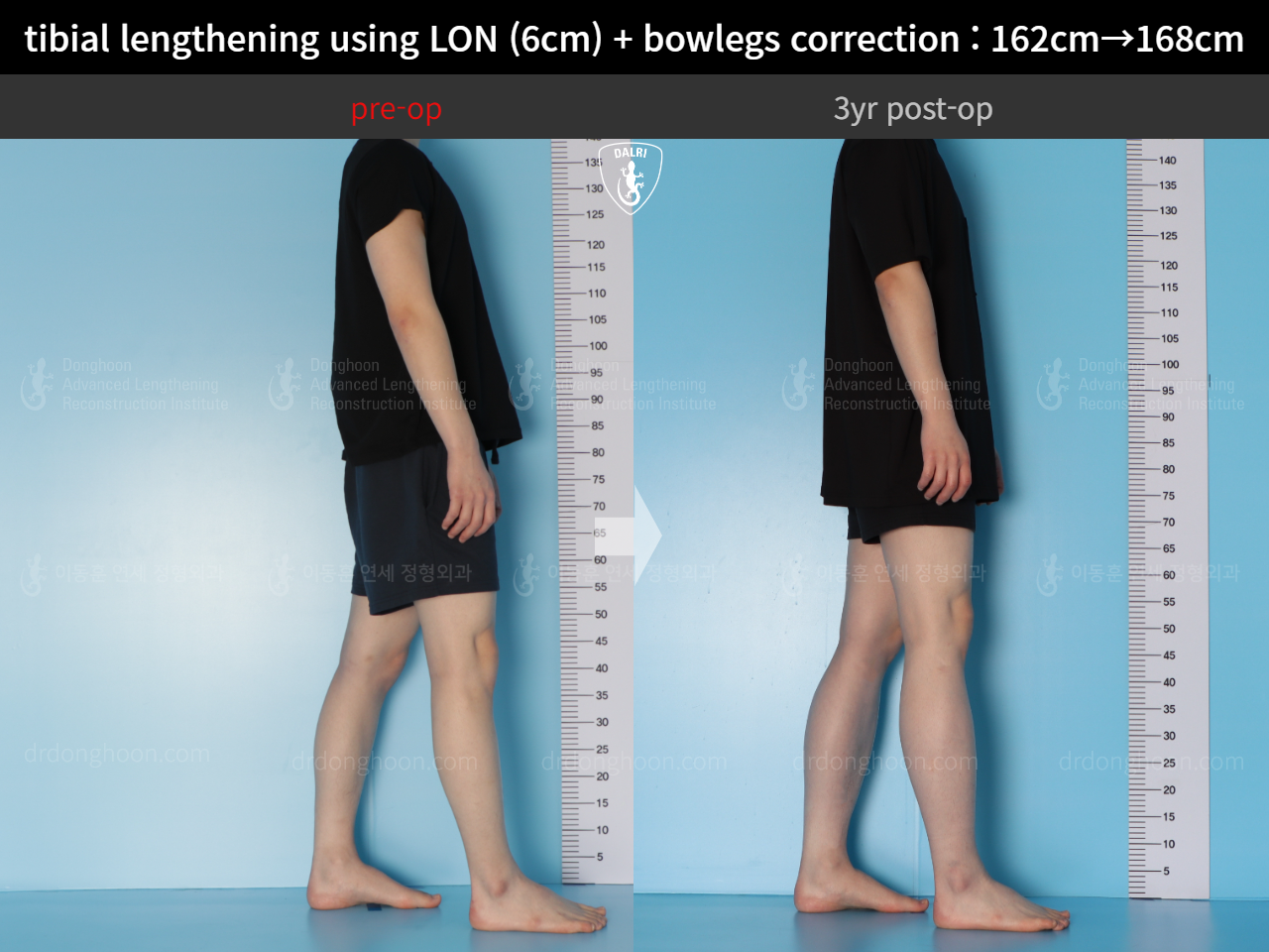 Before and after cll + deformity correction, case 14731799, image 4, Dr. Donghoon institute (DALRI)