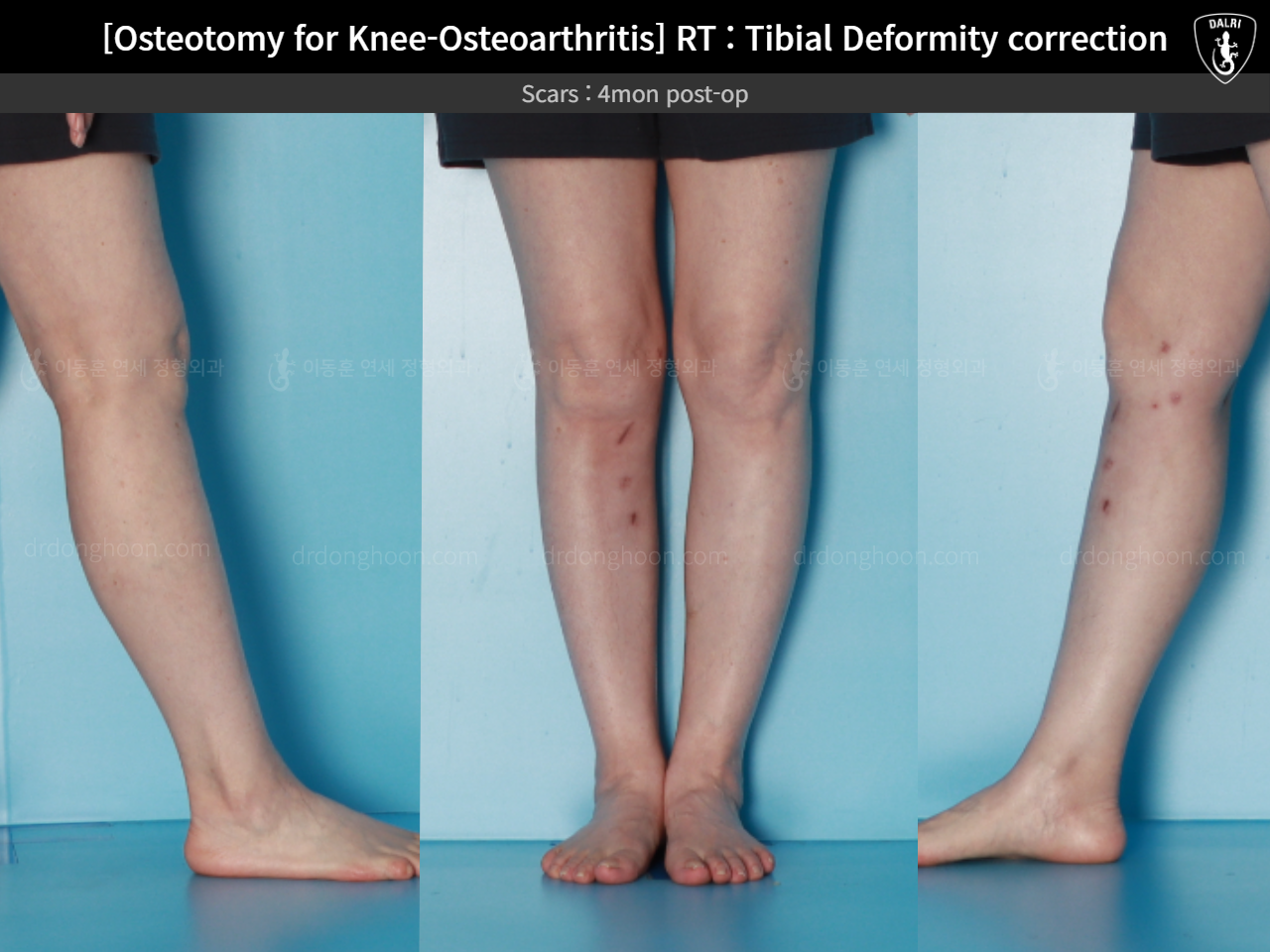 Before and after osteotomy for knee osteoarthritis, case 17890677, image 9, Dr. Donghoon institute (DALRI)