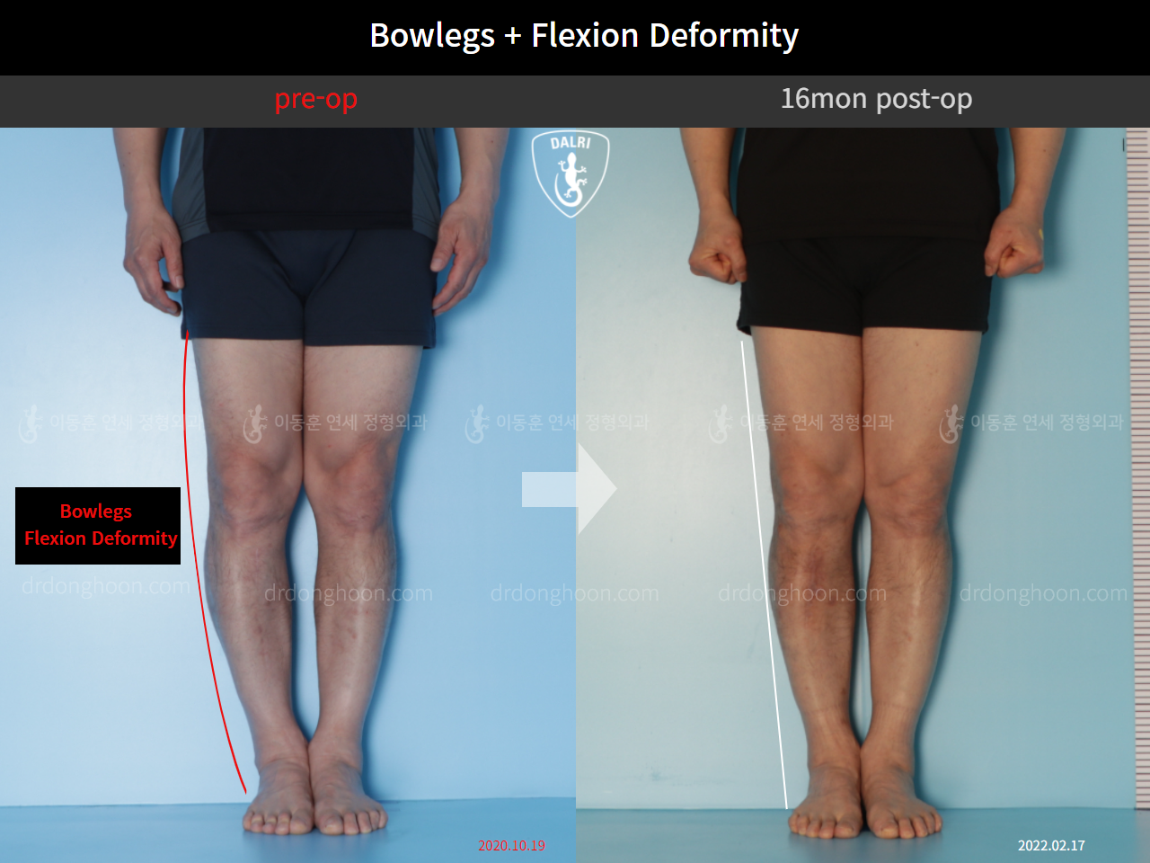 Before and after adult bowlegs, case 10451182, image 4, Dr. Donghoon institute (DALRI)