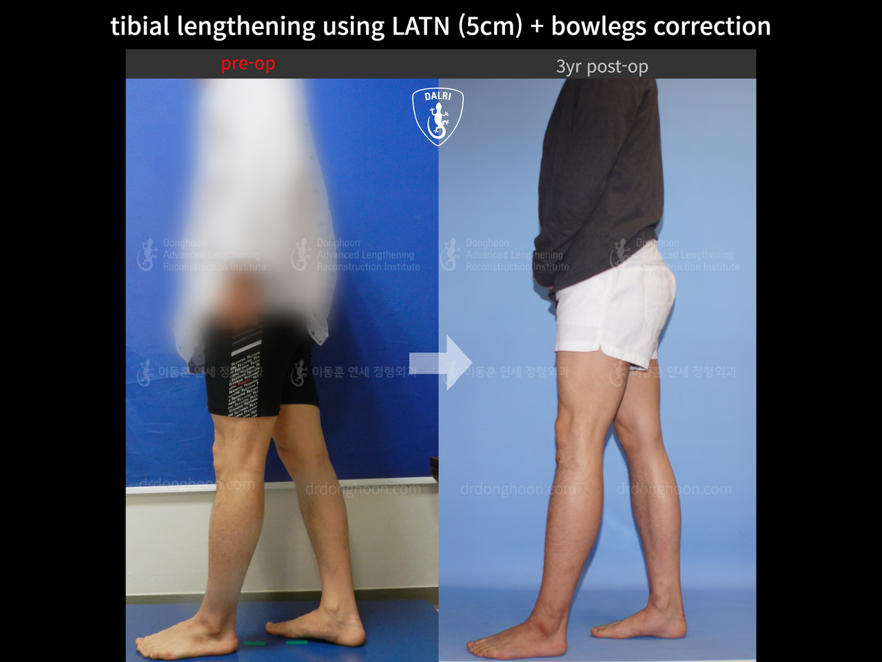 Before and after cll + deformity correction, case 13476494, image 6, Dr. Donghoon institute (DALRI)