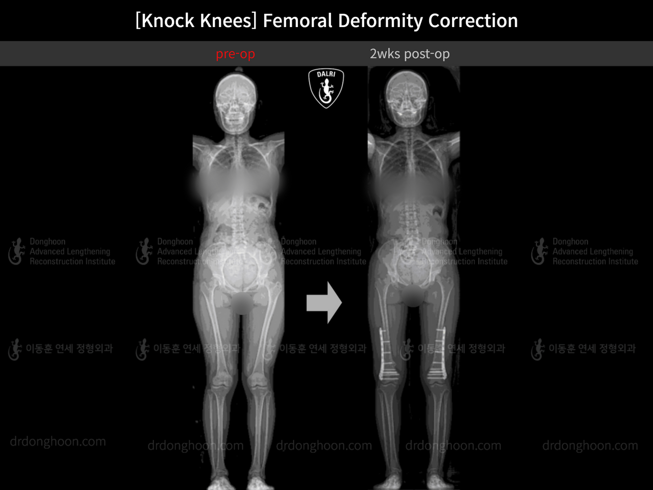 Before and after adult knock knees, case 14343877, image 6, Dr. Donghoon institute (DALRI)