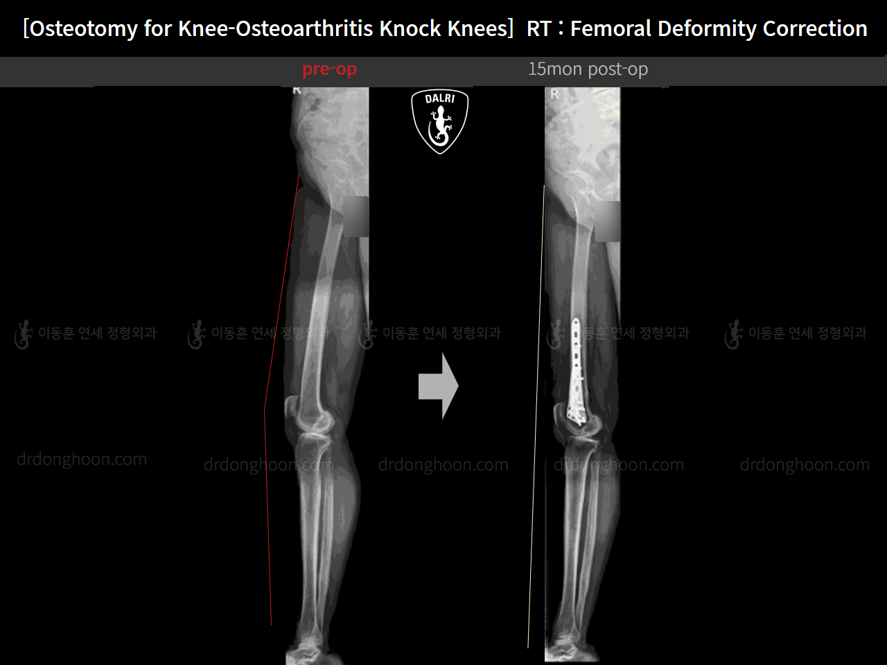 Before and after osteotomy for knee osteoarthritis, case 14462707, image 11, Dr. Donghoon institute (DALRI)