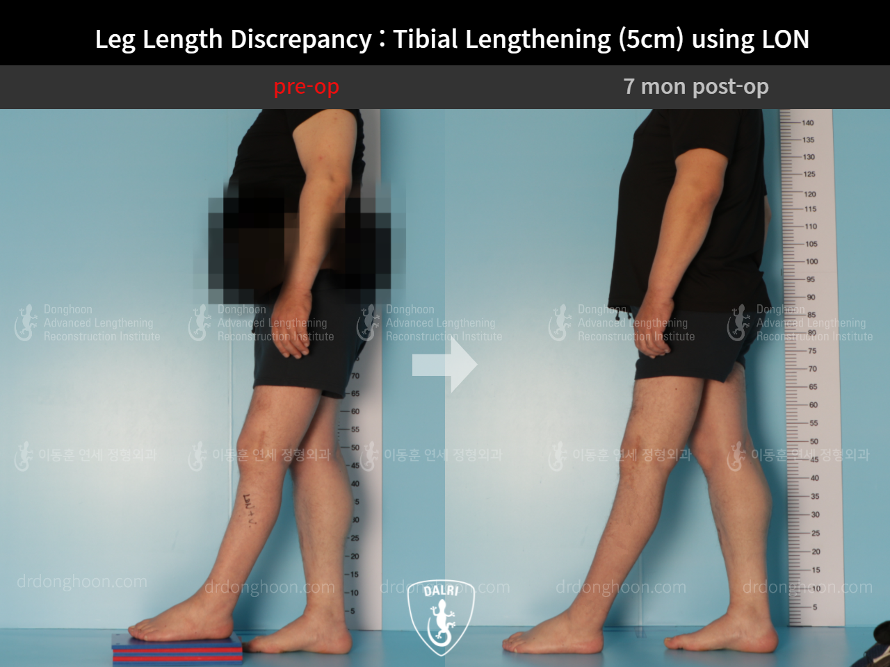 Before and after adult lld, case 9165807, image 3, Dr. Donghoon institute (DALRI)