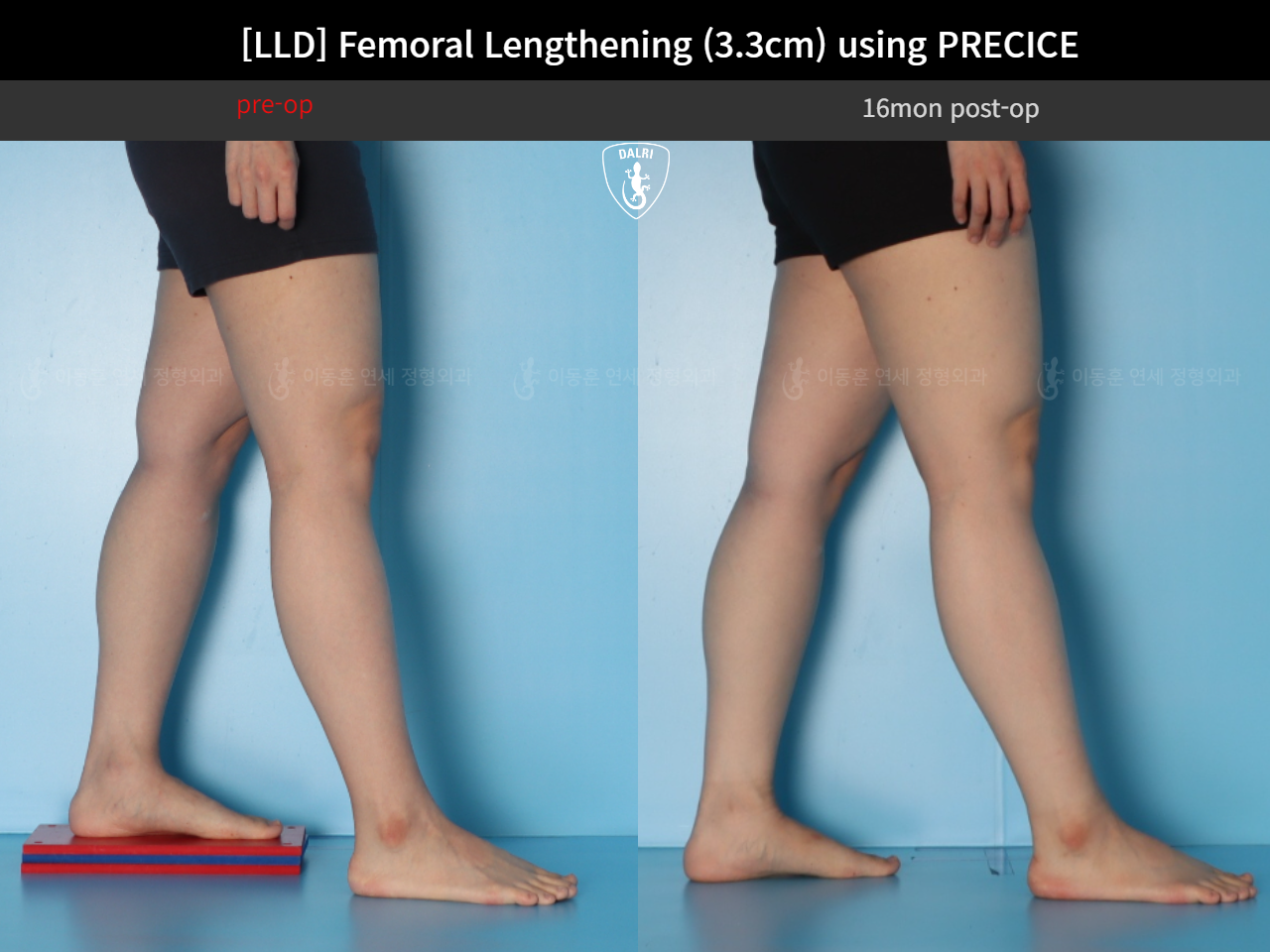 Before and after adult lld, case 125639660, image 8, Dr. Donghoon institute (DALRI)