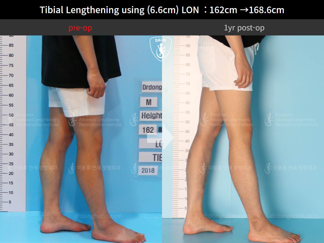 Before and after cll lon, case 4577769, image 7, Dr. Donghoon institute (DALRI)