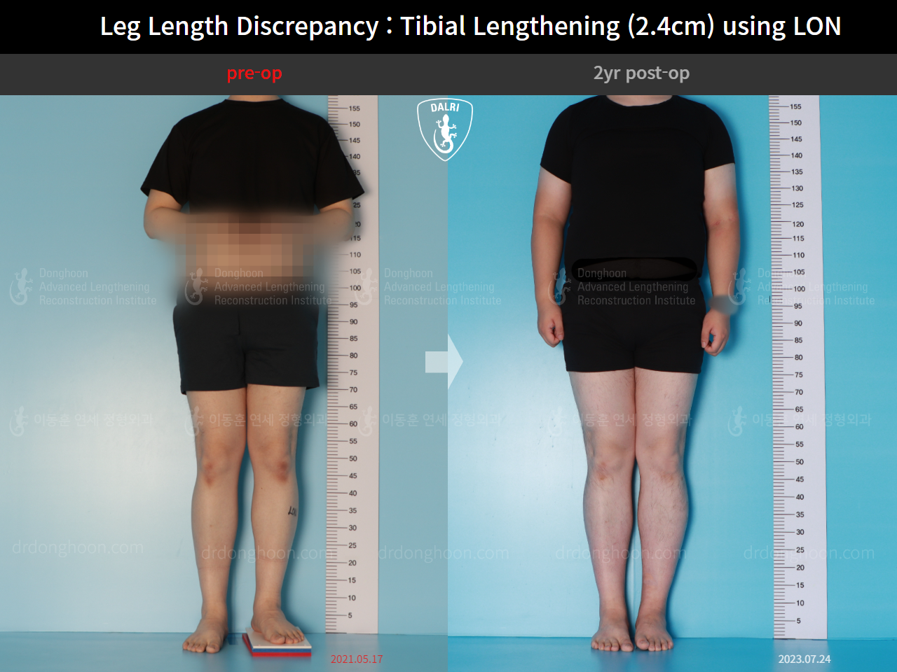Before and after adult lld, case 15877698, image 1, Dr. Donghoon institute (DALRI)