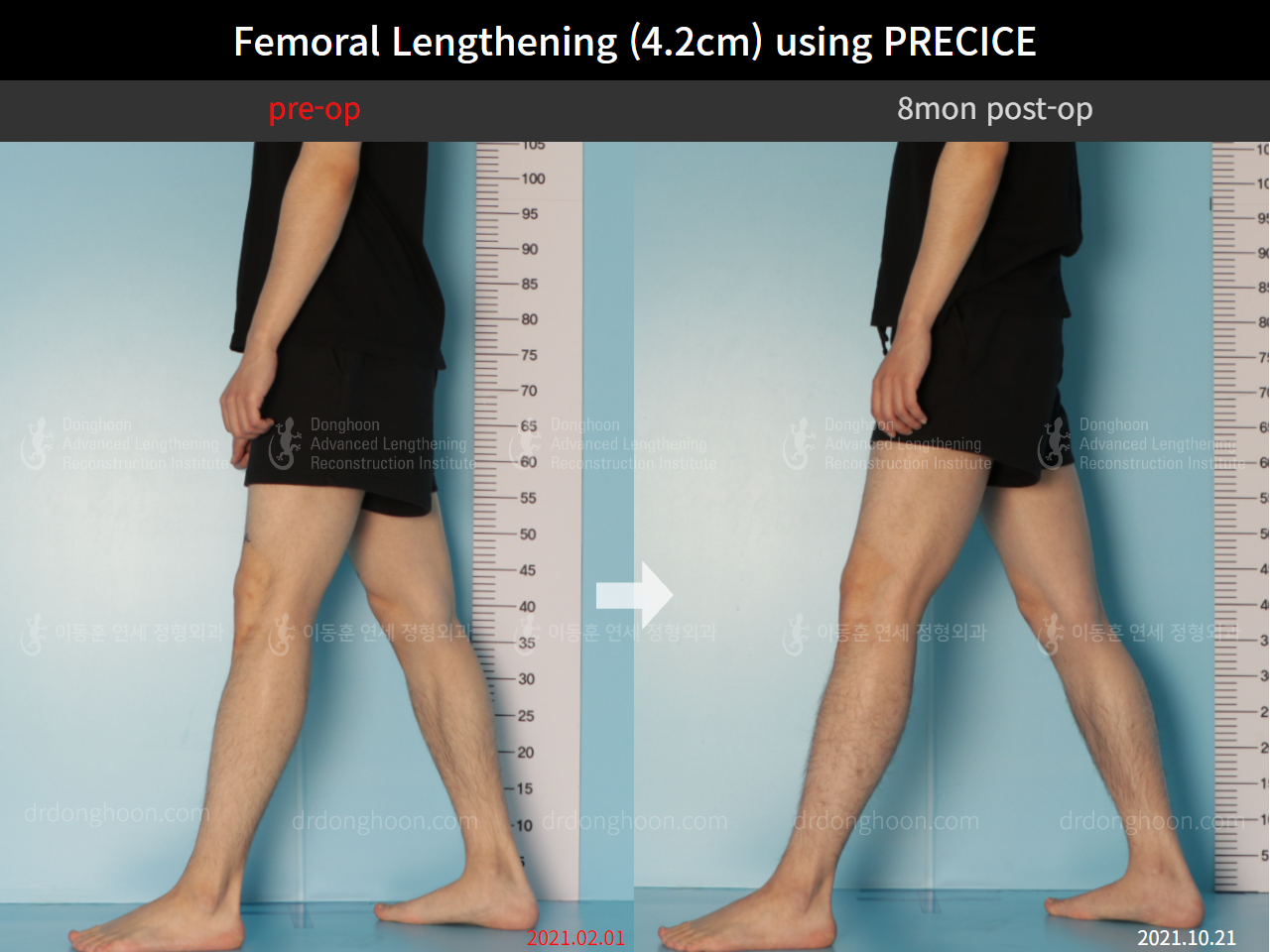 Before and after cll precice, case 8781700, image 8, Dr. Donghoon institute (DALRI)