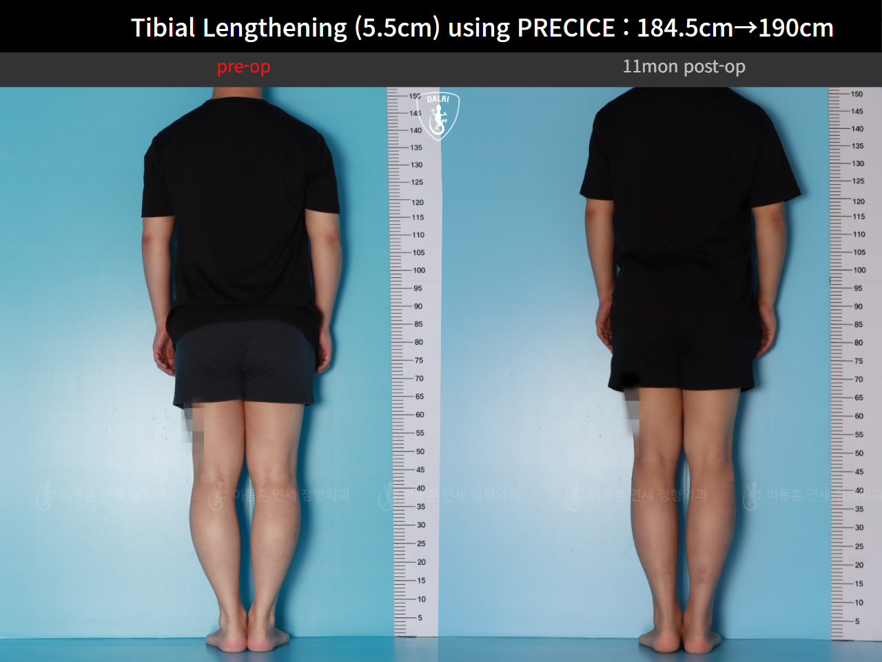 Before and after cll precice, case 125279355, image 3, Dr. Donghoon institute (DALRI)
