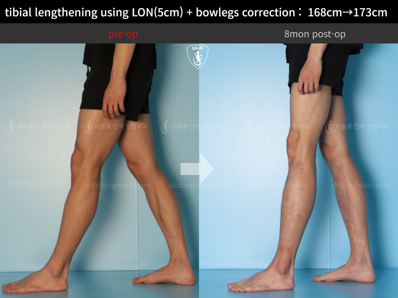 Before and after cll + deformity correction, case 13661181, image 10, Dr. Donghoon institute (DALRI)
