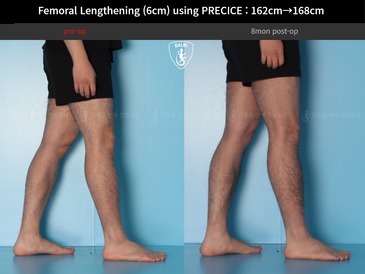 Before and after cll precice, case 52565195, image 10, Dr. Donghoon institute (DALRI)