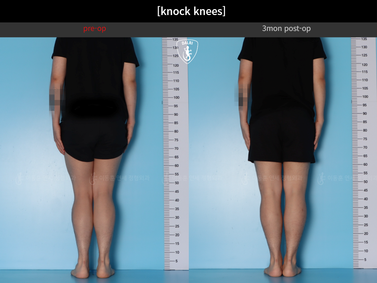 Before and after adult knock knees, case 124642361, image 4, Dr. Donghoon institute (DALRI)