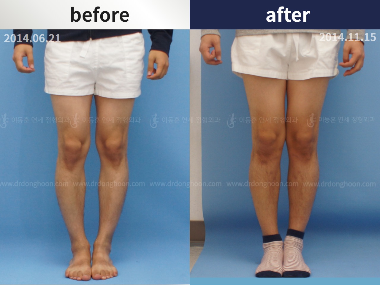 Before and after adult bowlegs, case 4311092, image 3, Dr. Donghoon institute (DALRI)