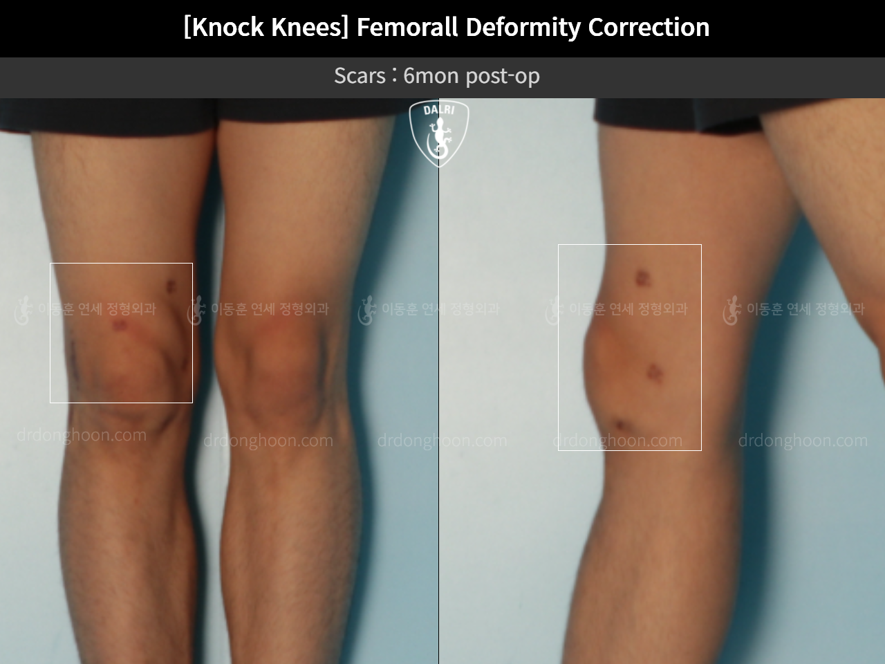 Before and after adult knock knees, case 11773301, image 5, Dr. Donghoon institute (DALRI)