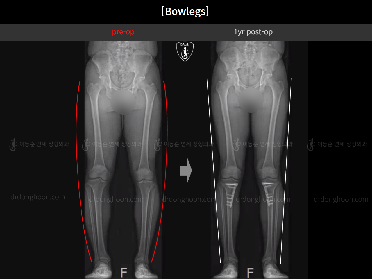 Before and after adult bowlegs, case 16724494, image 14, Dr. Donghoon institute (DALRI)