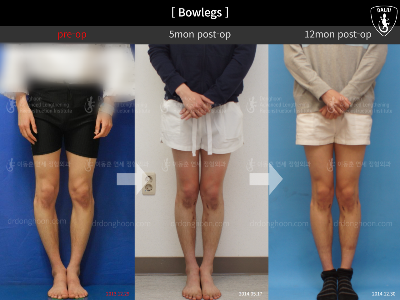 Before and after adult bowlegs, case 12756537, image 1, Dr. Donghoon institute (DALRI)