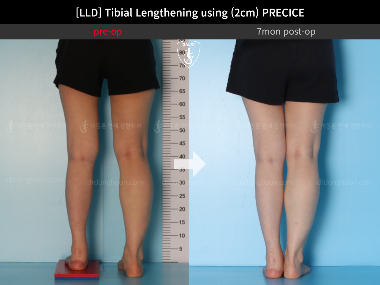 Before and after adult lld, case 12985023, image 6, Dr. Donghoon institute (DALRI)