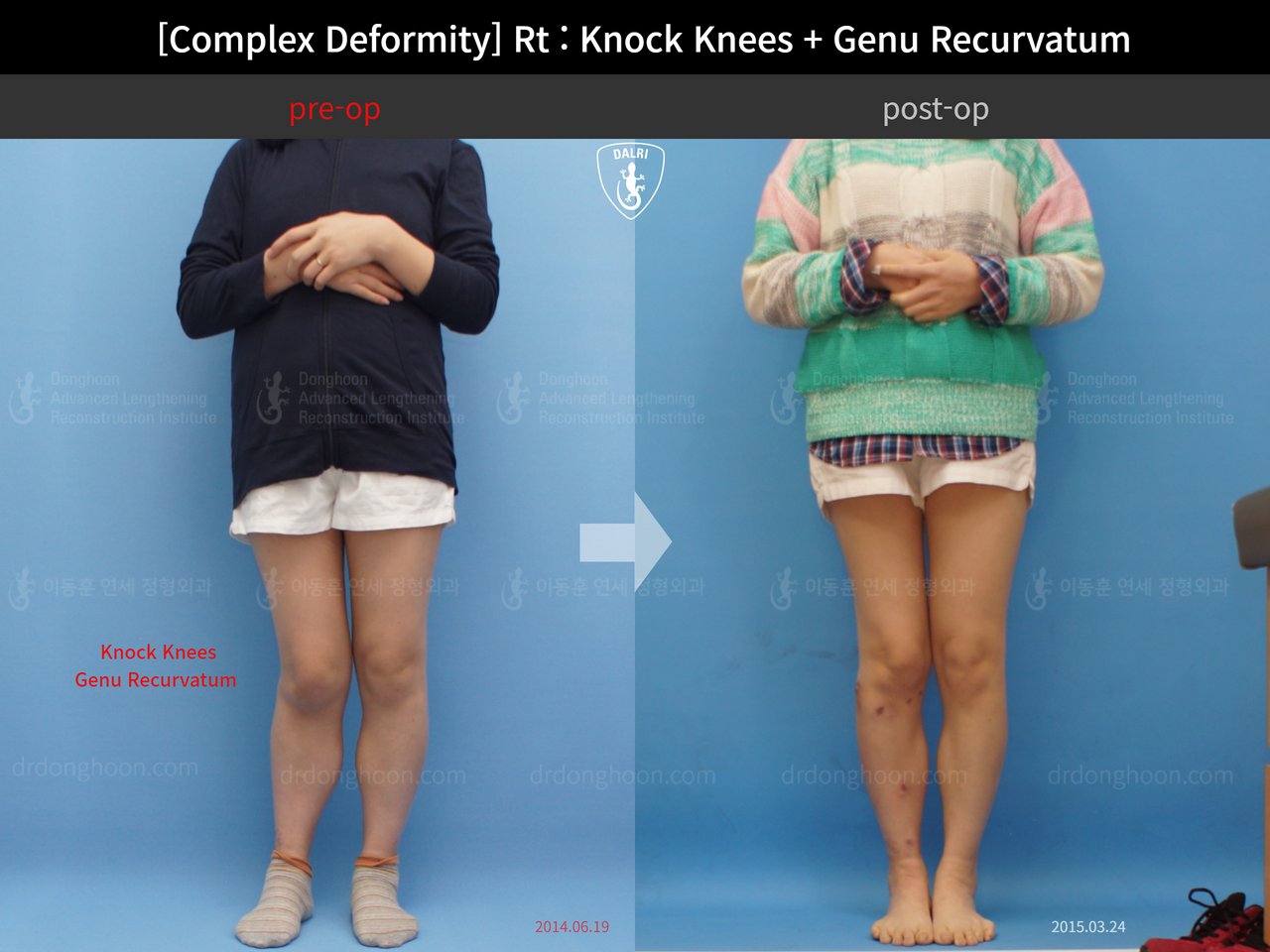 Before and after complex deformity, case 13204696, image 1, Dr. Donghoon institute (DALRI)