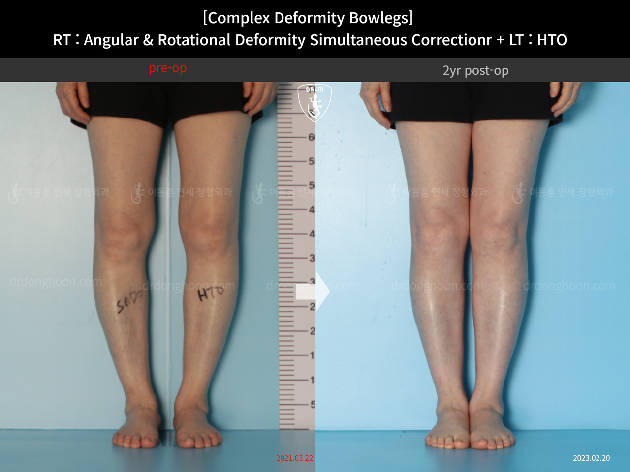 Before and after adult bowlegs, case 14328178, image 3, Dr. Donghoon institute (DALRI)