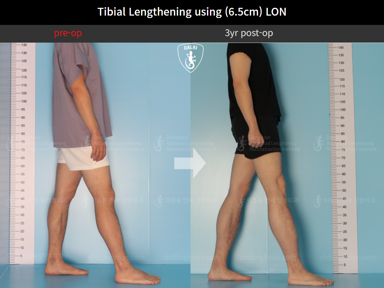 Before and after cll lon, case 9487829, image 4, Dr. Donghoon institute (DALRI)