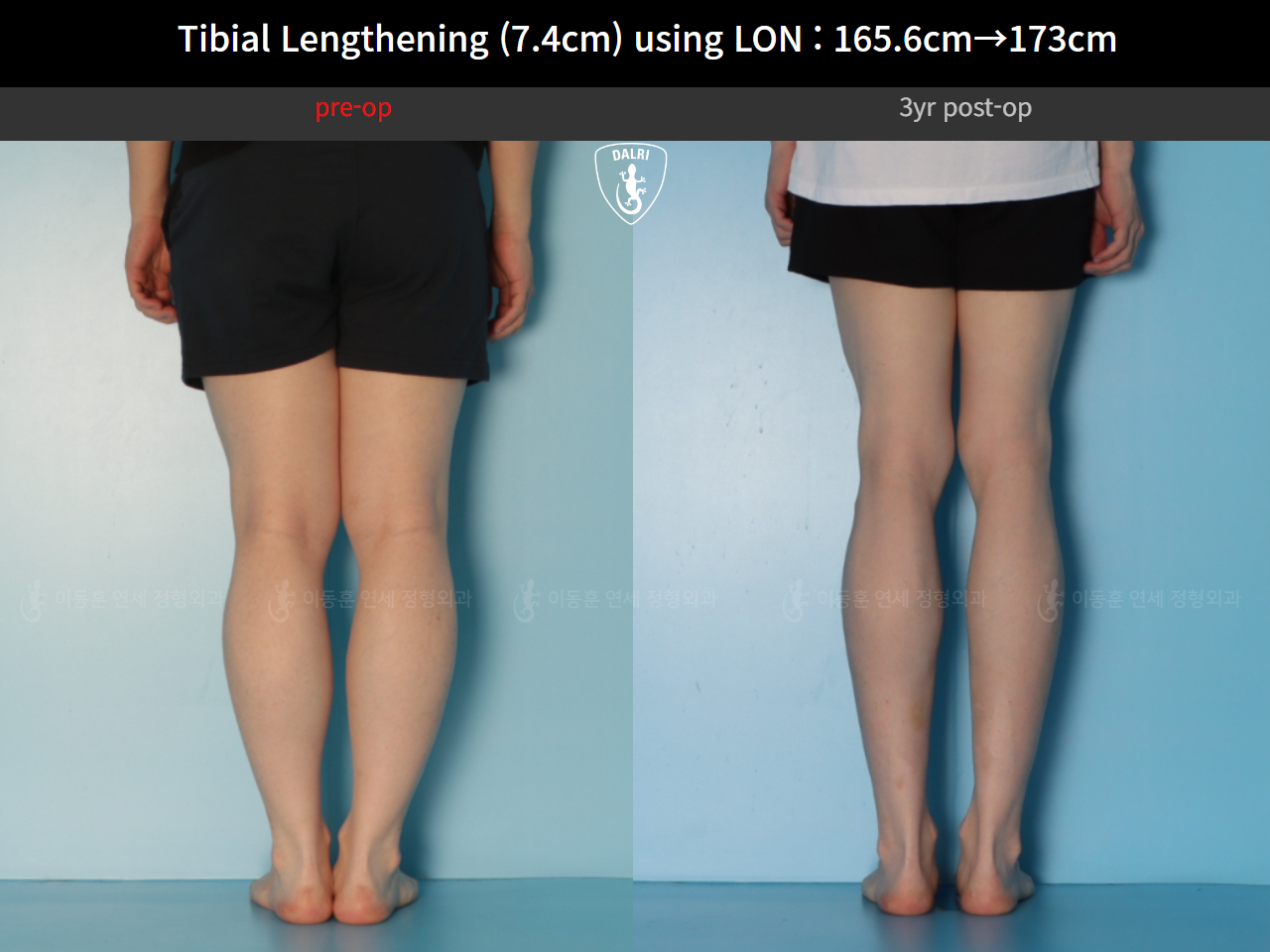 Before and after cll lon, case 125561518, image 8, Dr. Donghoon institute (DALRI)