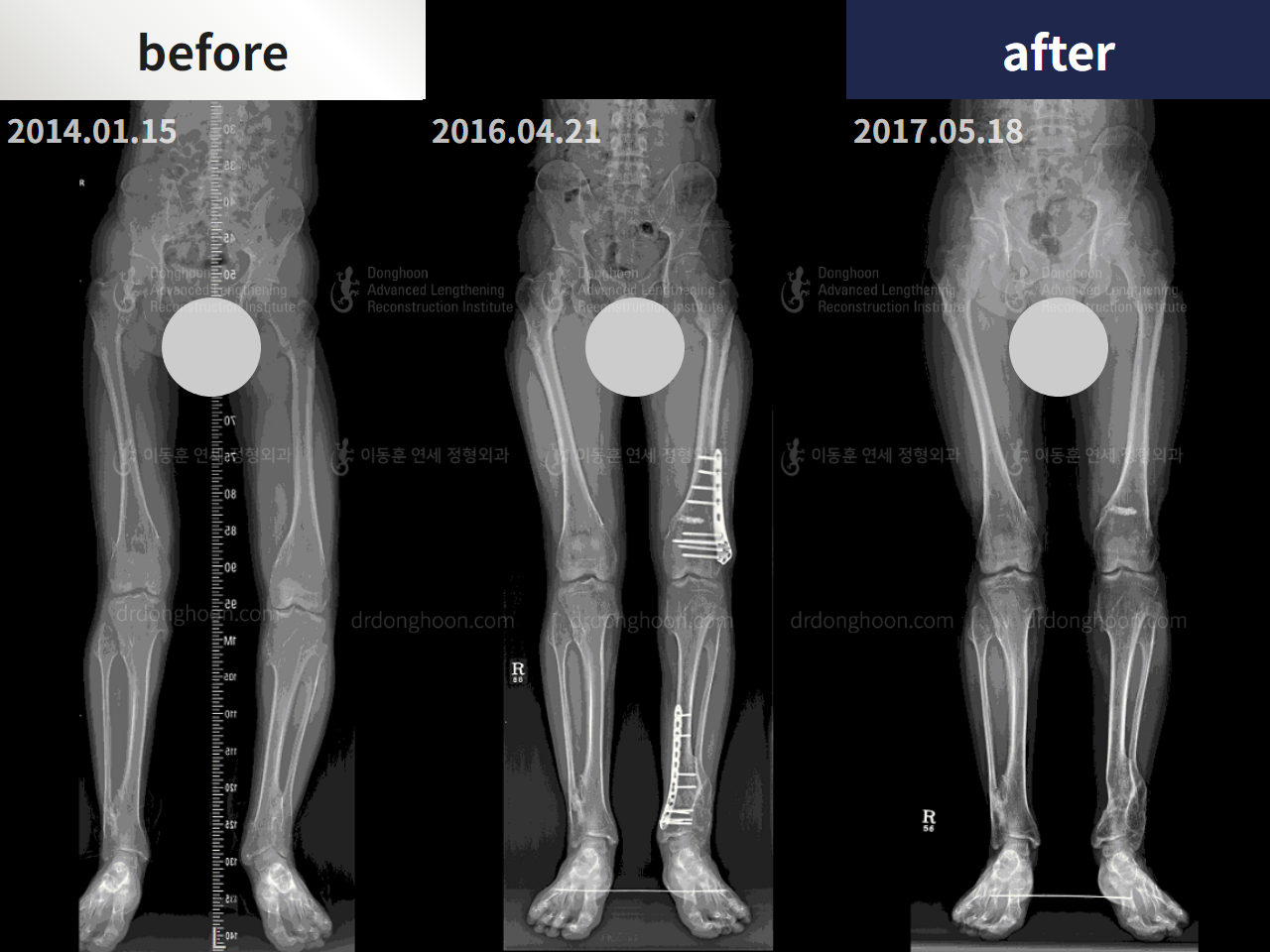 Before and after congenital condition, case 4304662, image 3, Dr. Donghoon institute (DALRI)
