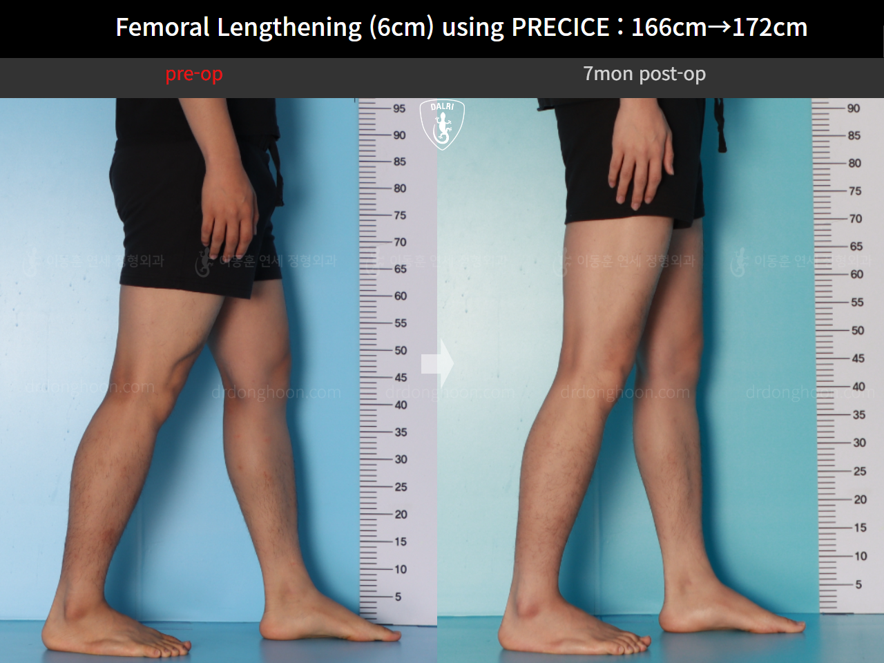 Before and after cll precice, case 17579263, image 8, Dr. Donghoon institute (DALRI)