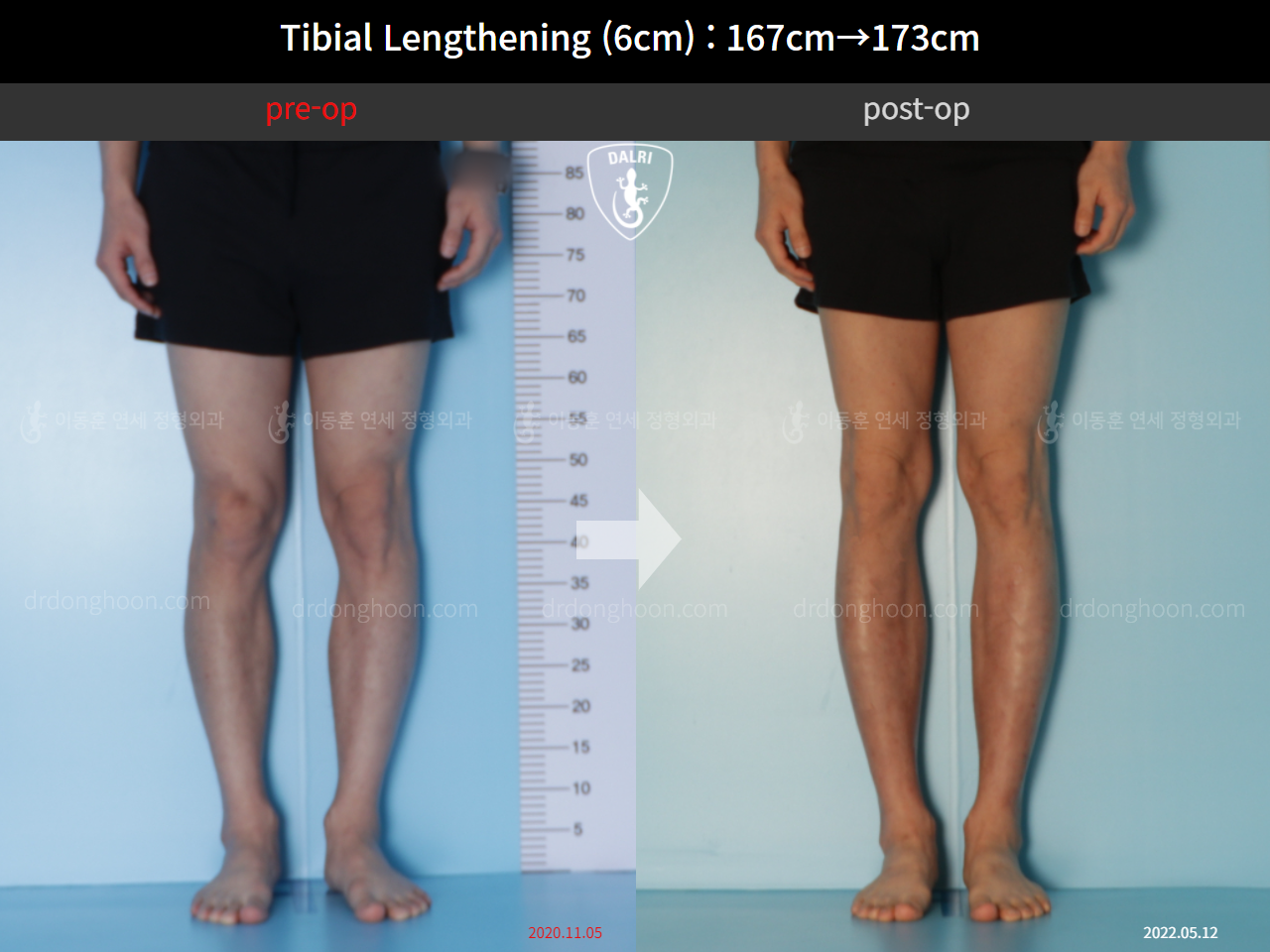 Before and after cll precice, case 11510560, image 5, Dr. Donghoon institute (DALRI)
