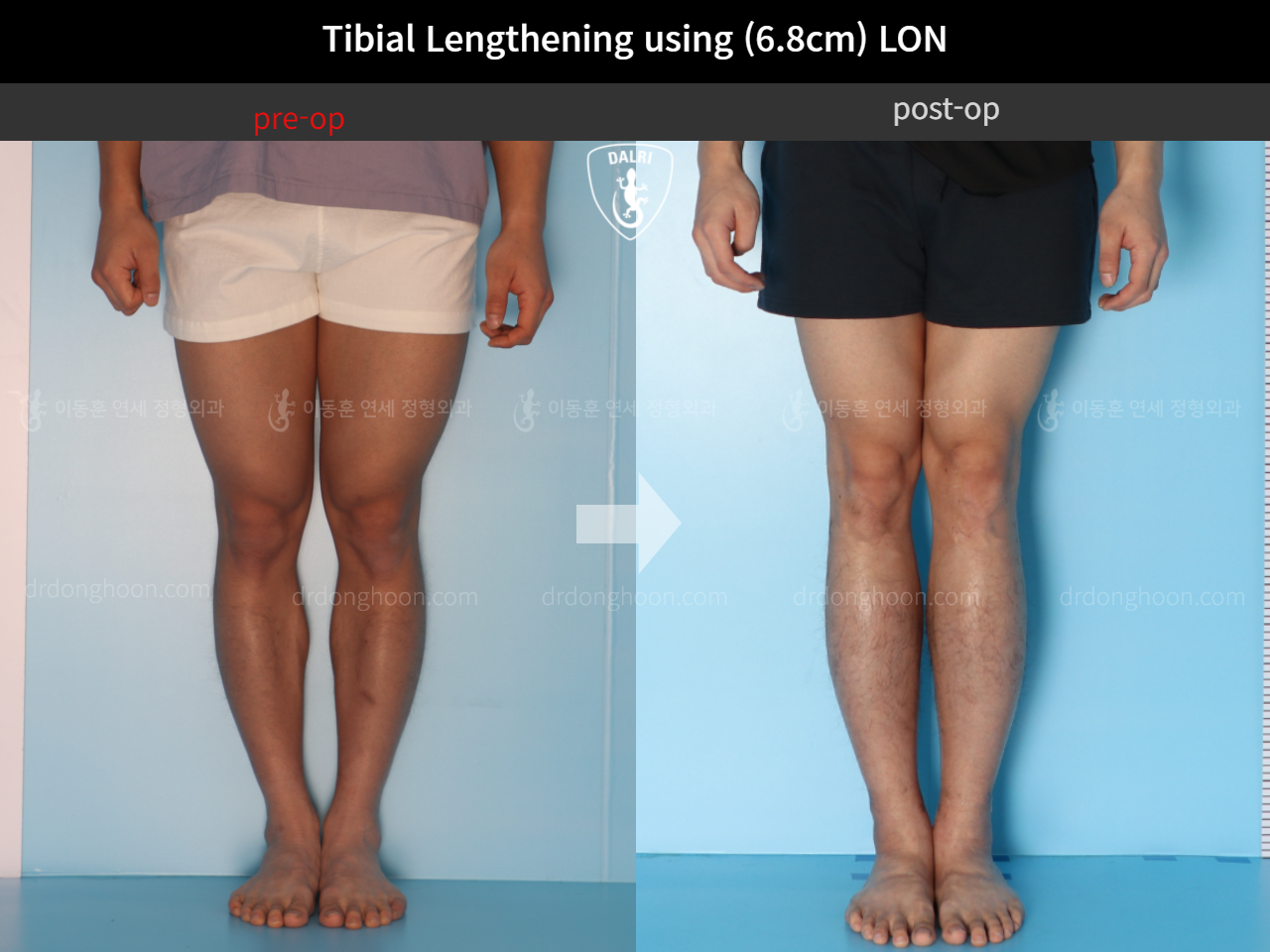 Before and after cll lon, case 4577738, image 5, Dr. Donghoon institute (DALRI)