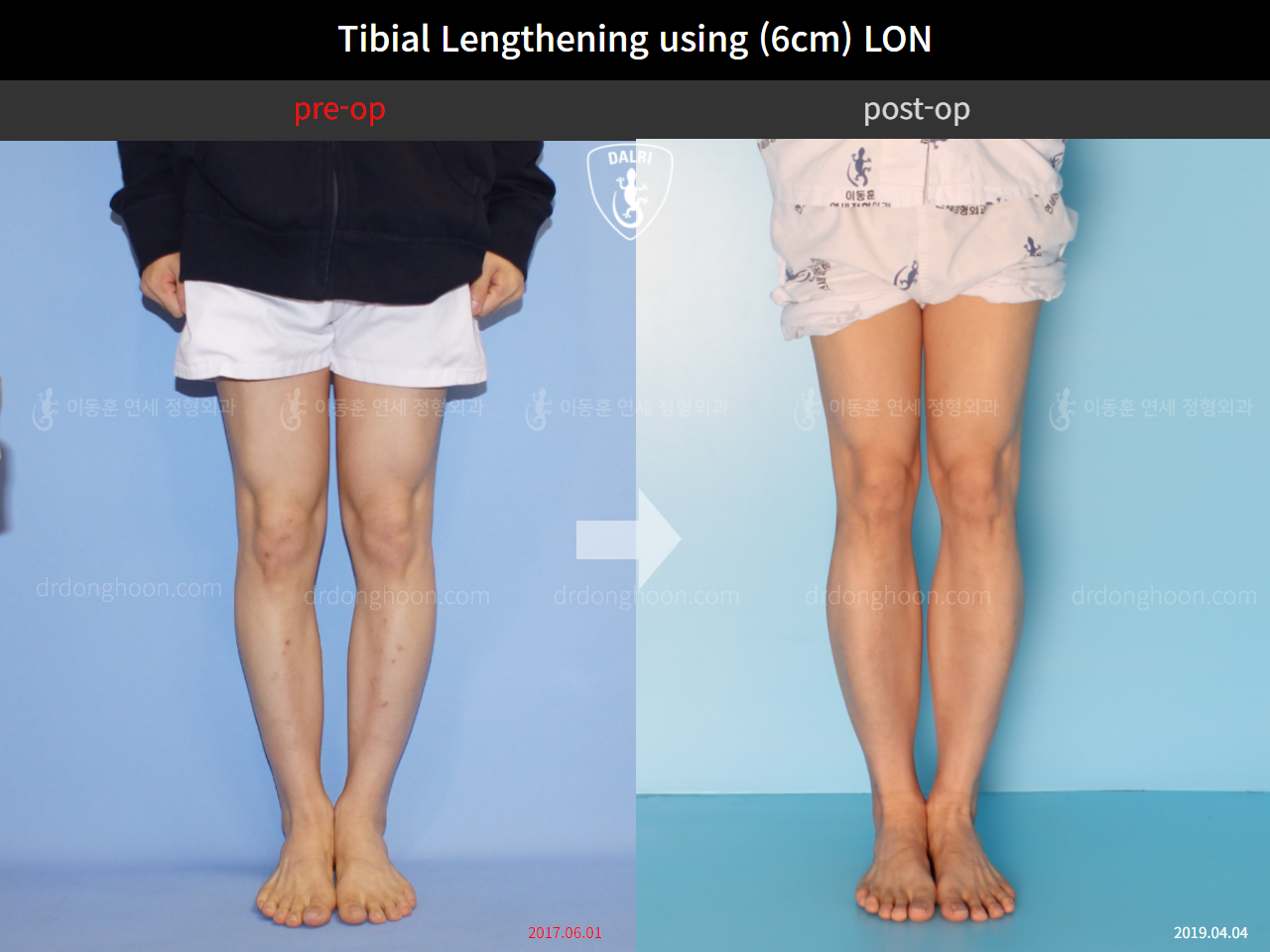 Before and after cll lon, case 4577694, image 5, Dr. Donghoon institute (DALRI)