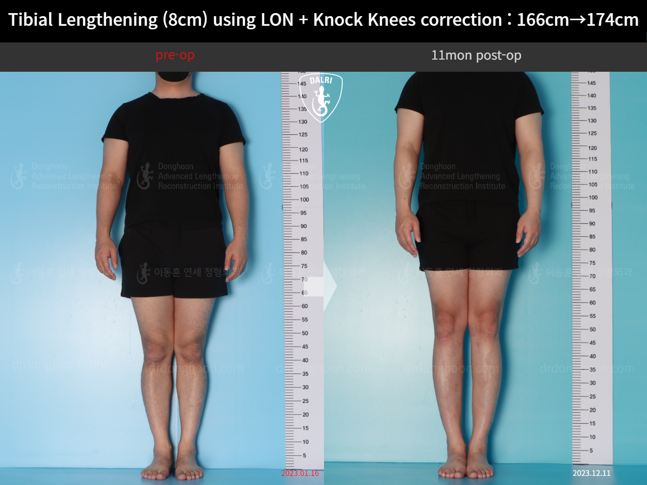 Before and after cll + deformity correction, case 20789954, image 1, Dr. Donghoon institute (DALRI)
