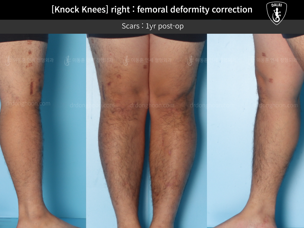 Before and after adult knock knees, case 13582115, image 5, Dr. Donghoon institute (DALRI)