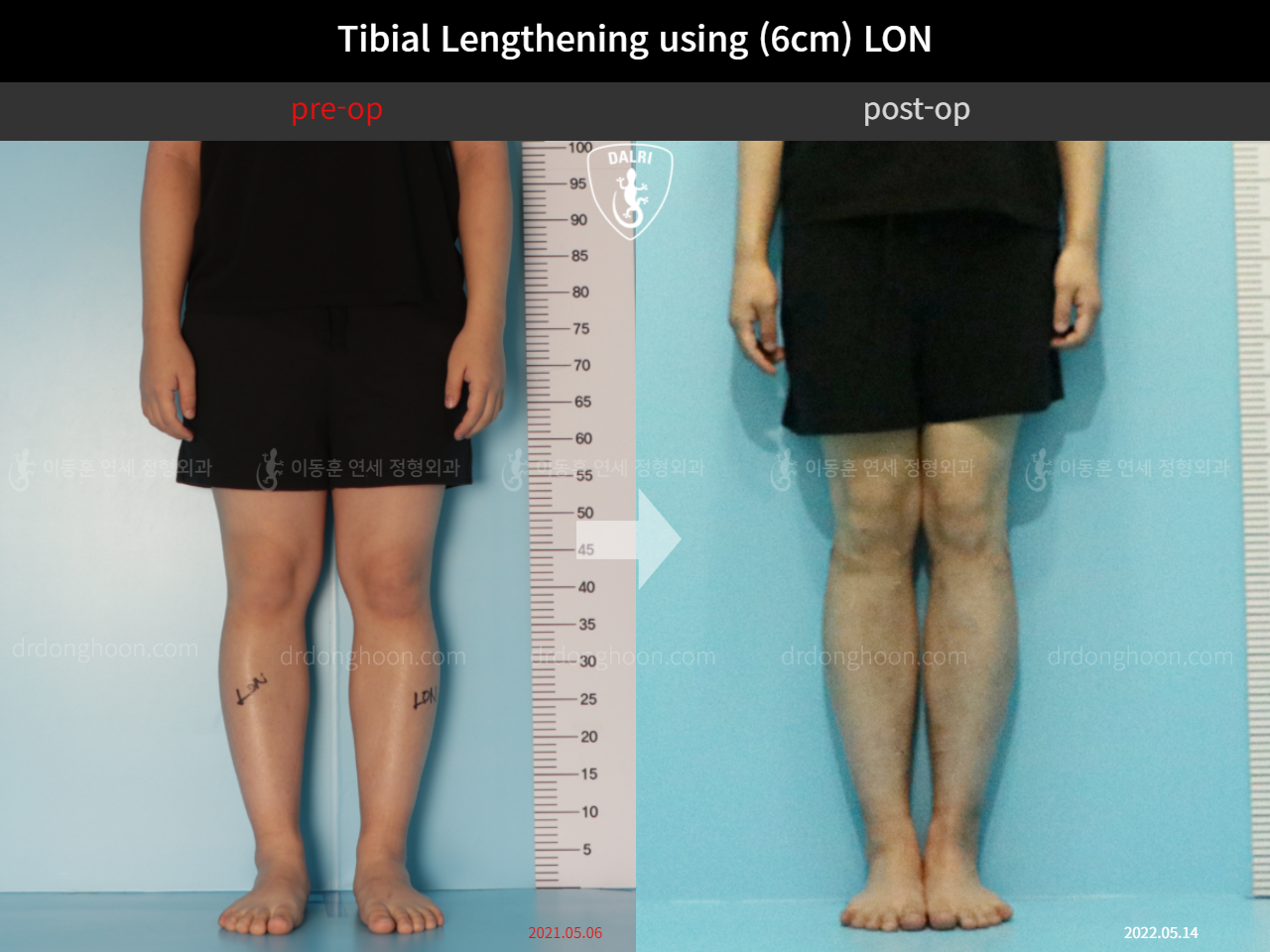 Before and after cll lon, case 11511553, image 3, Dr. Donghoon institute (DALRI)