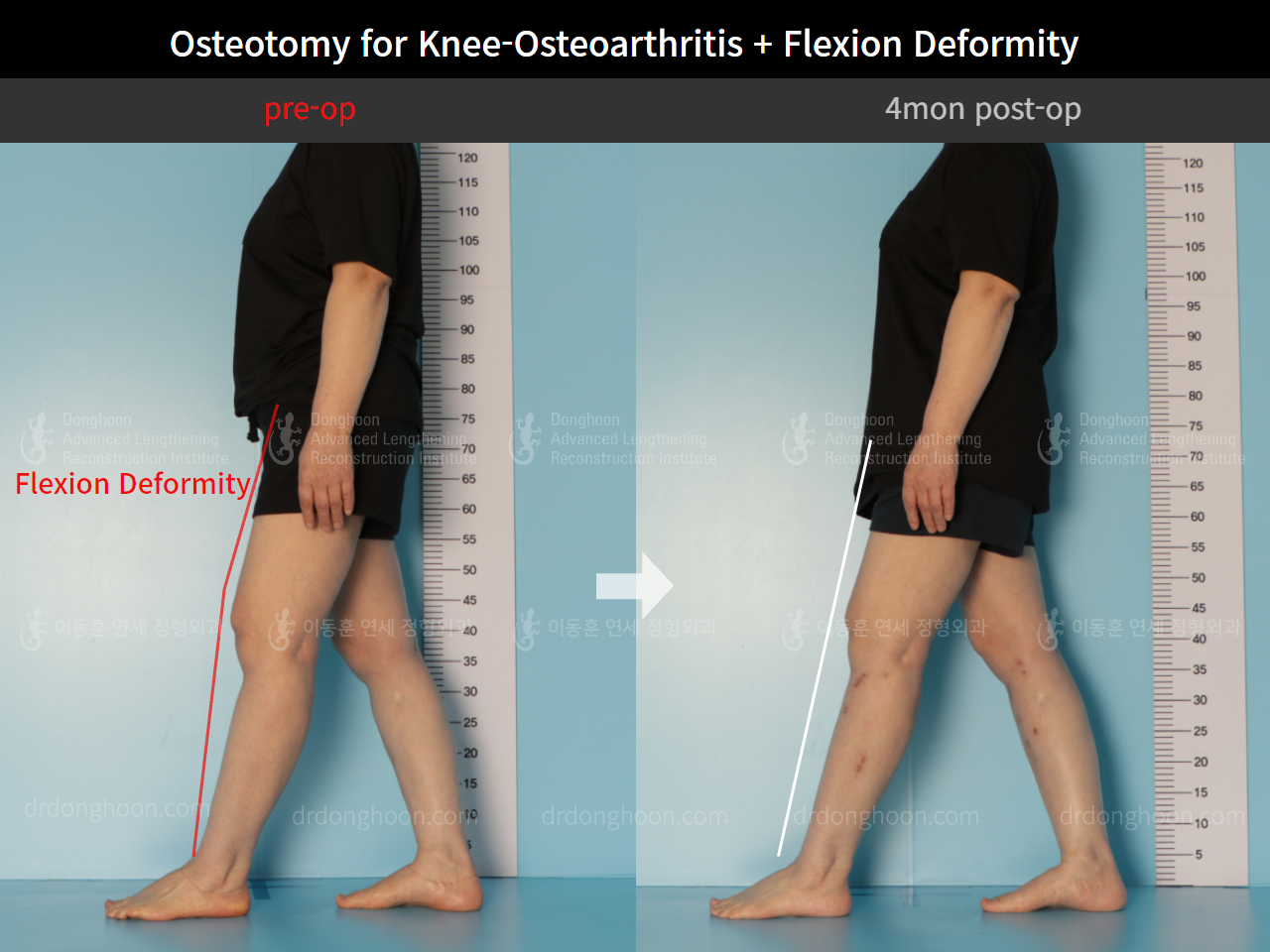 Before and after osteotomy for knee osteoarthritis, case 8803663, image 4, Dr. Donghoon institute (DALRI)
