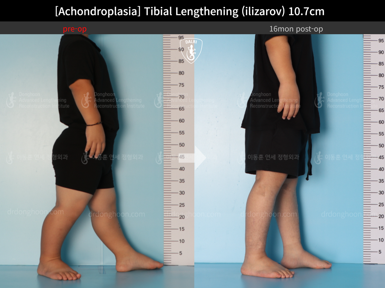 Before and after paediatric congenital condition, case 13489647, image 10, Dr. Donghoon institute (DALRI)