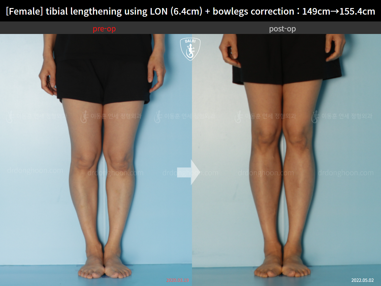 Before and after cll lon, case 15615051, image 5, Dr. Donghoon institute (DALRI)