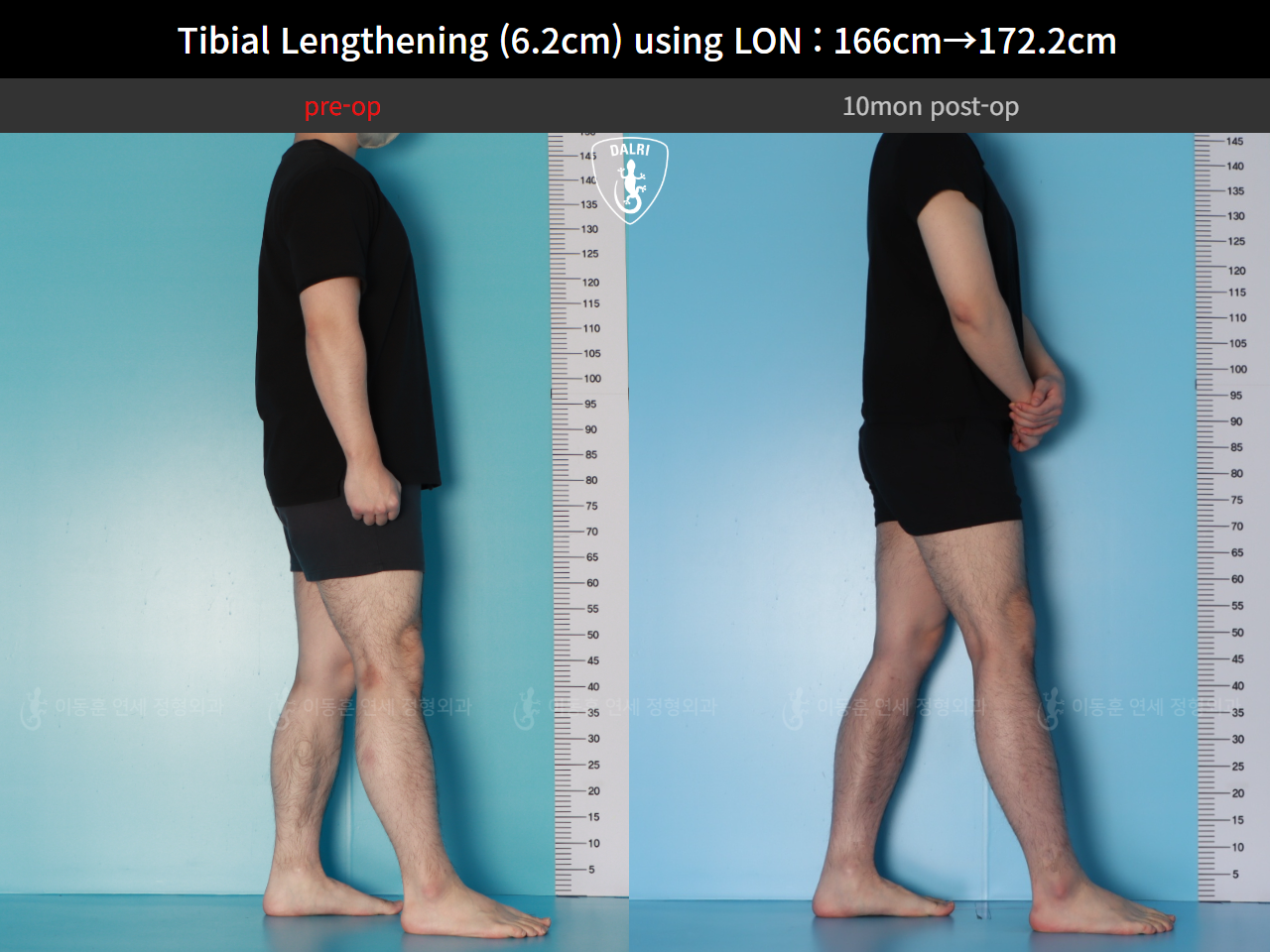 Before and after cll lon, case 128591201, image 7, Dr. Donghoon institute (DALRI)