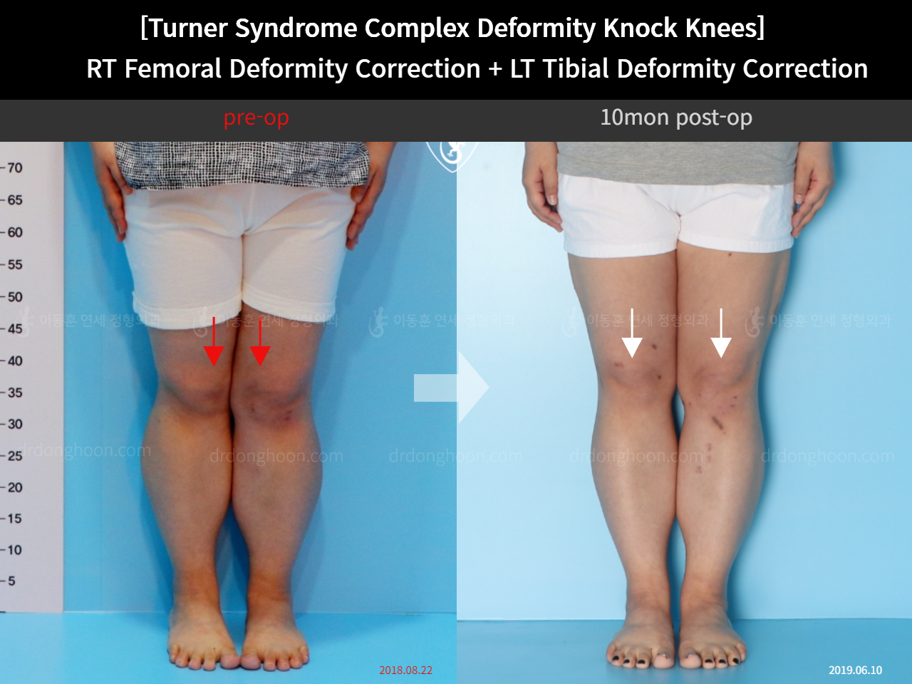 Before and after congenital condition, case 4640660, image 3, Dr. Donghoon institute (DALRI)