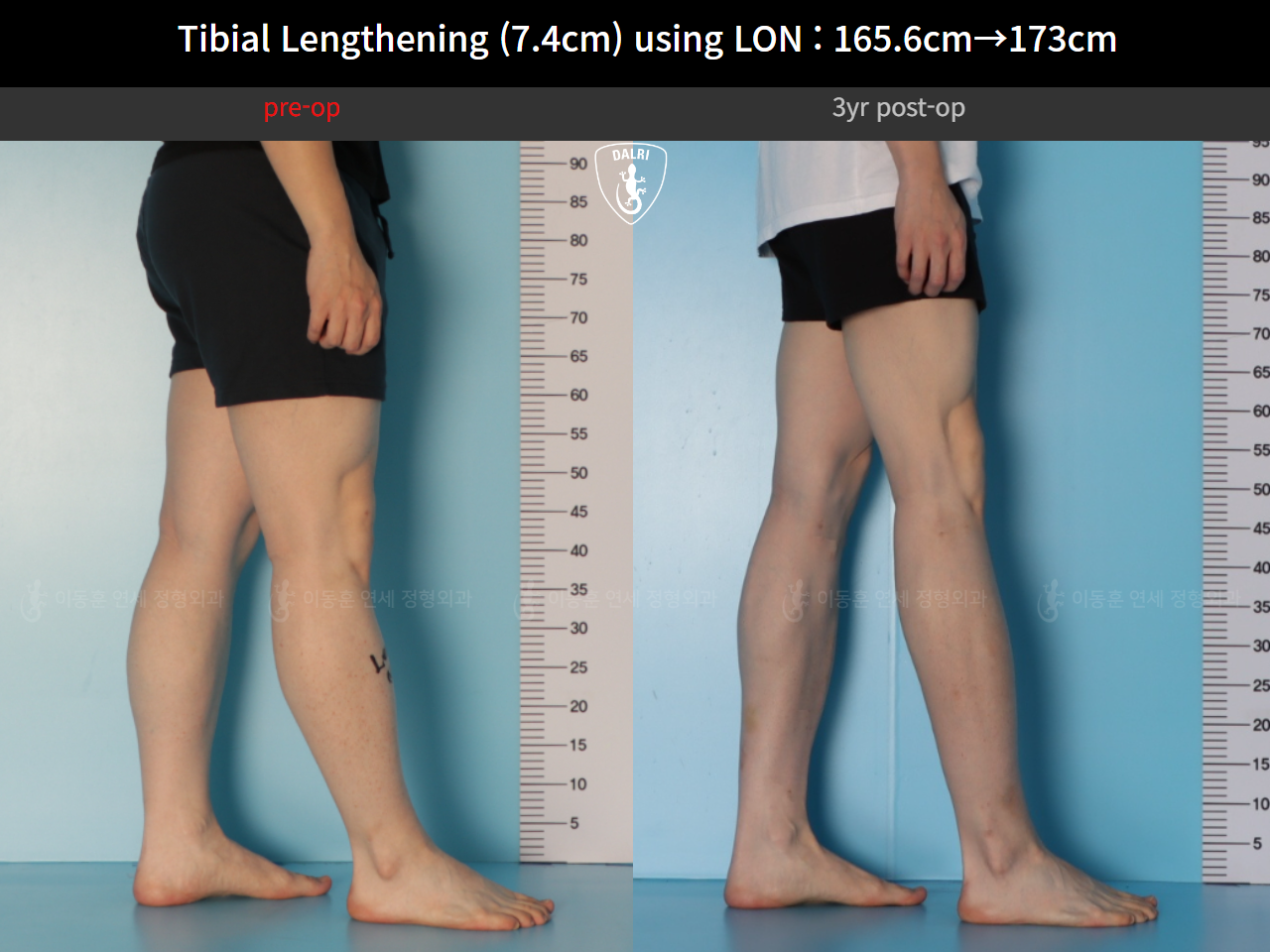 Before and after cll lon, case 125561518, image 10, Dr. Donghoon institute (DALRI)