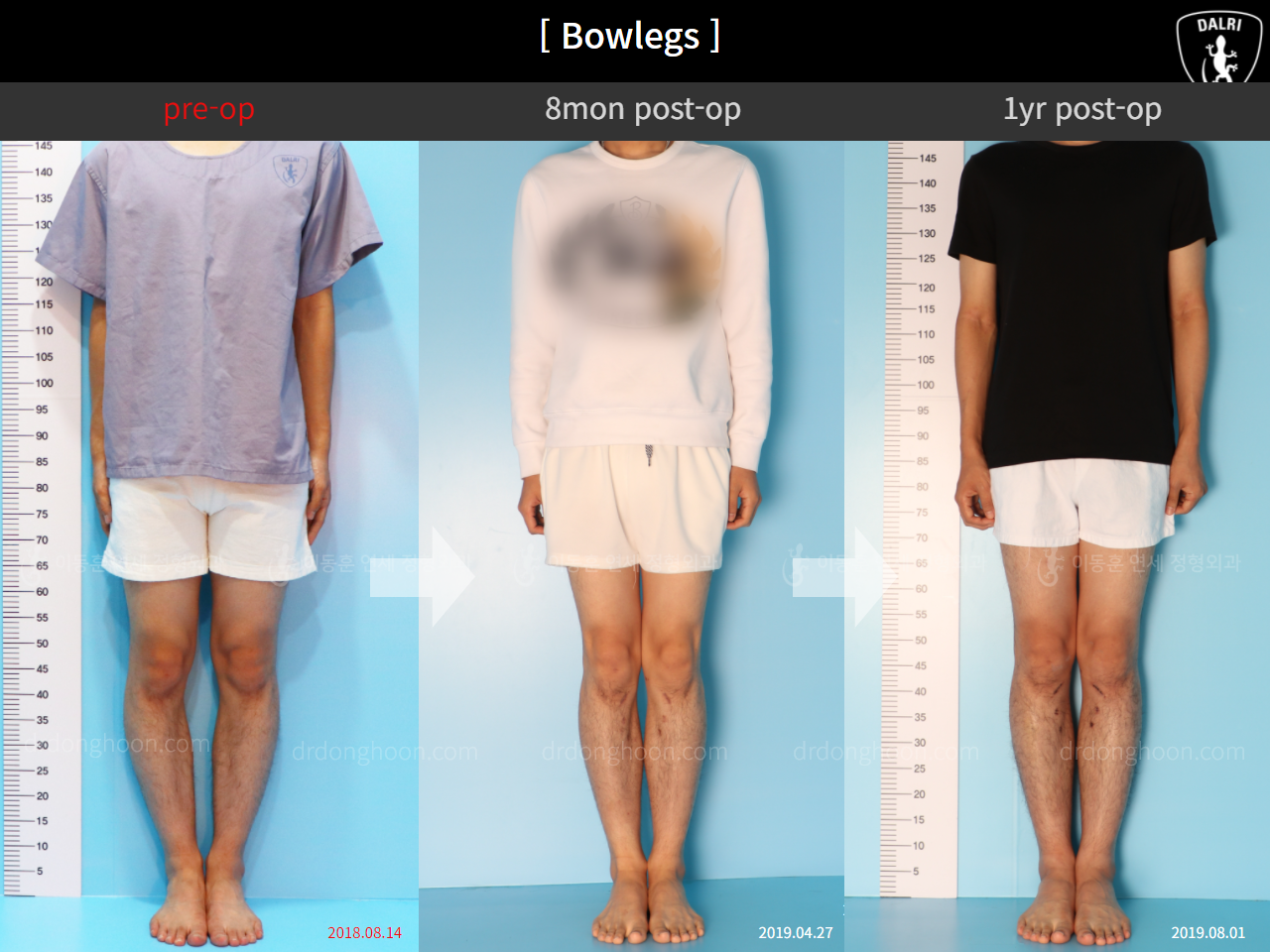 Before and after adult bowlegs, case 4311053, image 1, Dr. Donghoon institute (DALRI)