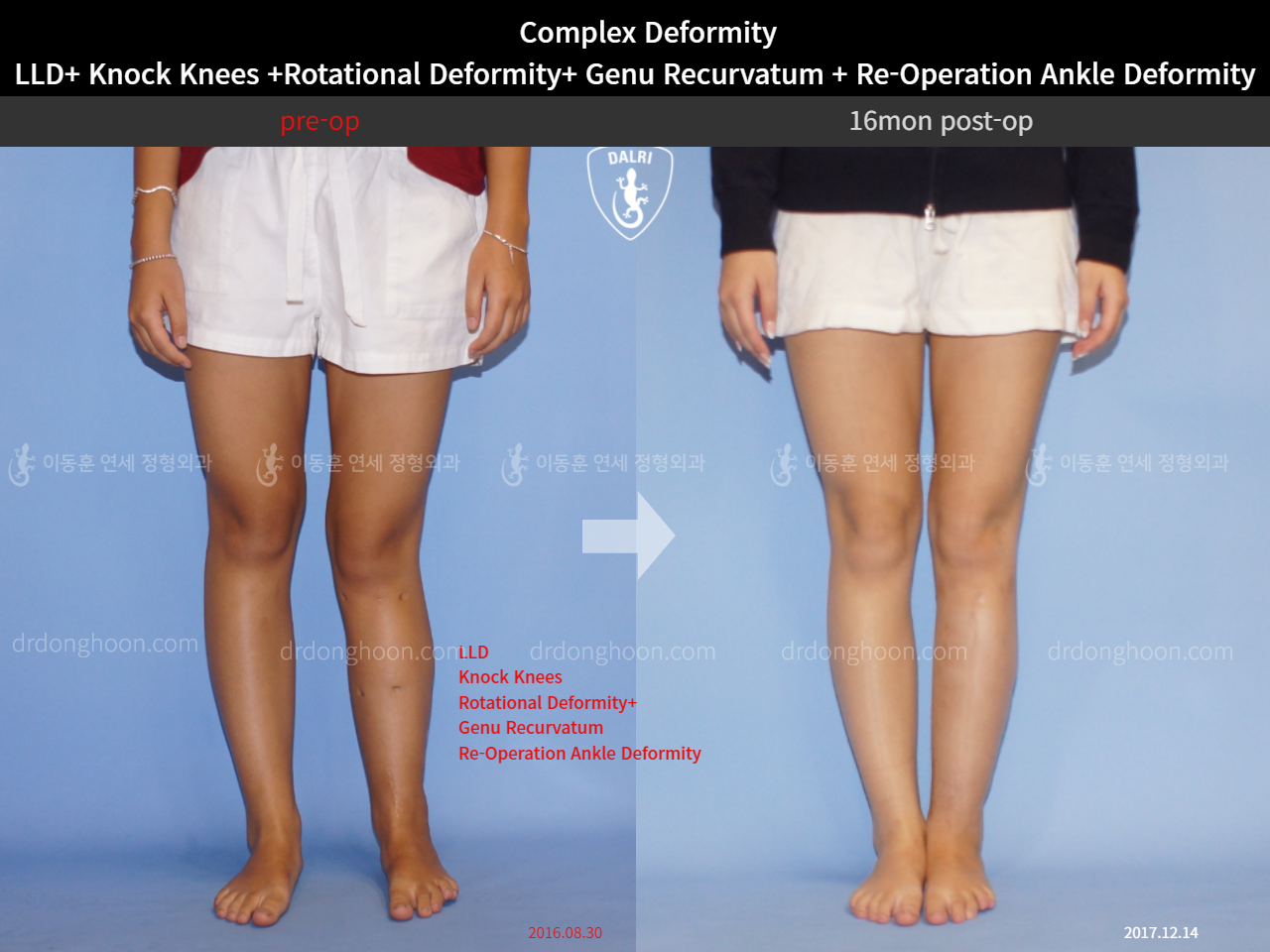 Before and after adult lld, case 5301879, image 4, Dr. Donghoon institute (DALRI)