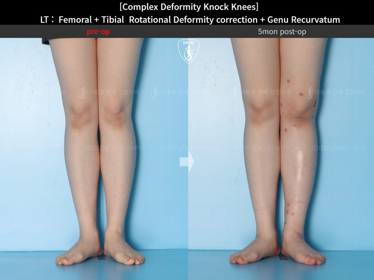 Before and after adult knock knees, case 16212764, image 10, Dr. Donghoon institute (DALRI)