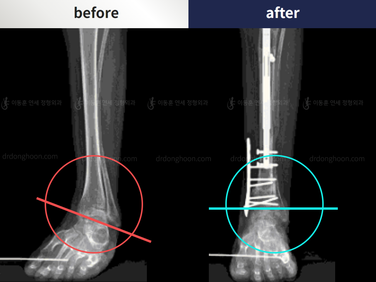 Before and after complex deformity, case 4795338, image 4, Dr. Donghoon institute (DALRI)