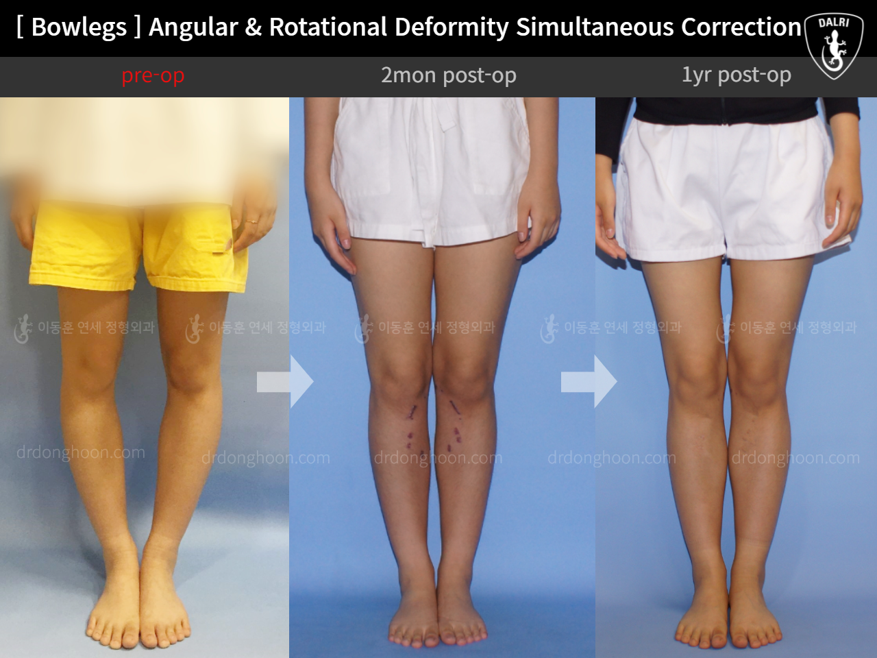 Before and after adult bowlegs, case 9036639, image 3, Dr. Donghoon institute (DALRI)