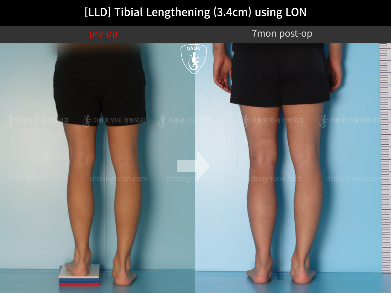 Before and after adult lld, case 12529689, image 5, Dr. Donghoon institute (DALRI)