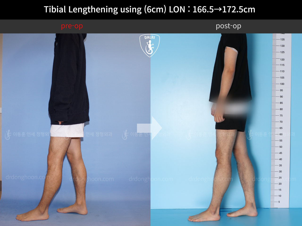 Before and after cll lon, case 11980239, image 4, Dr. Donghoon institute (DALRI)