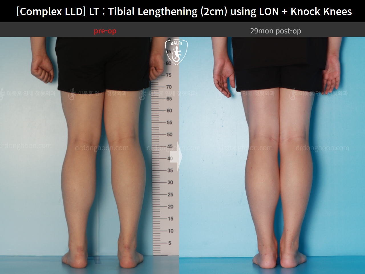 Before and after adult lld, case 16165477, image 6, Dr. Donghoon institute (DALRI)