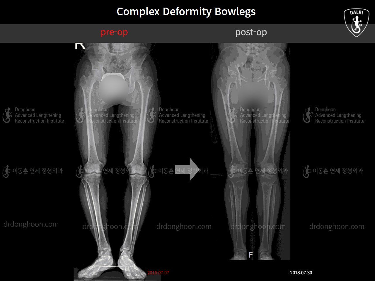 Before and after adult bowlegs, case 4311059, image 6, Dr. Donghoon institute (DALRI)
