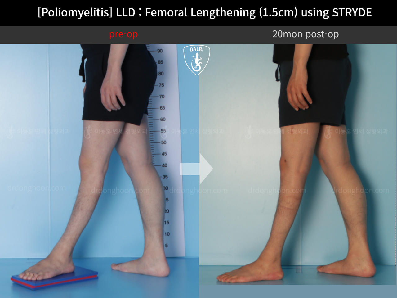 Before and after adult lld, case 12335486, image 6, Dr. Donghoon institute (DALRI)