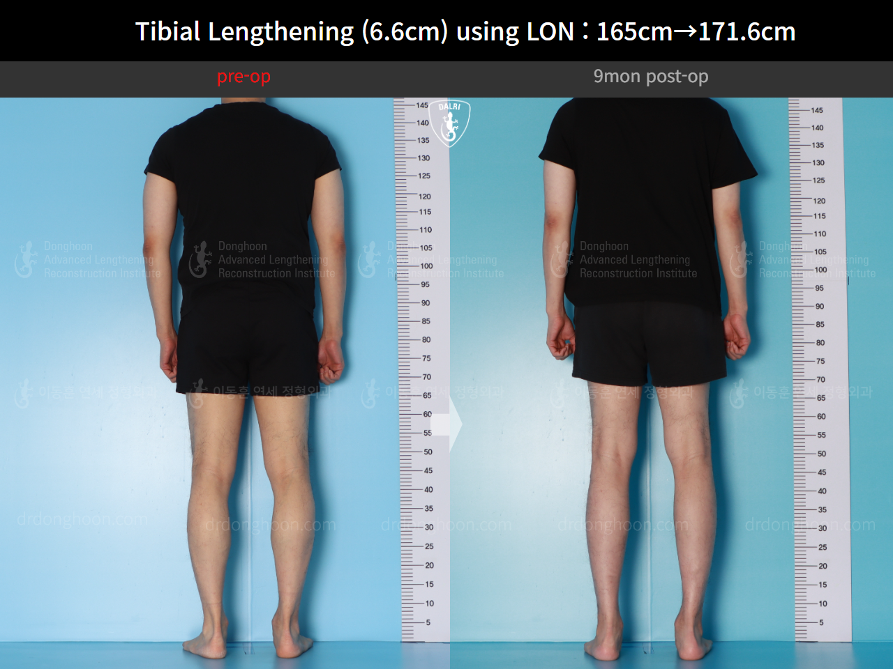 Before and after cll lon, case 16780660, image 4, Dr. Donghoon institute (DALRI)